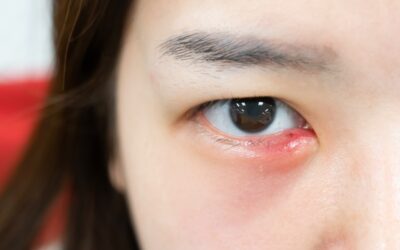 Eye Stye? Understanding and Dealing with Them – Quality Eye Care Clinic Explains