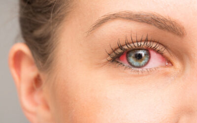 How IPL & RF Reduce Redness, Dark Circles, & Under Eye Bags