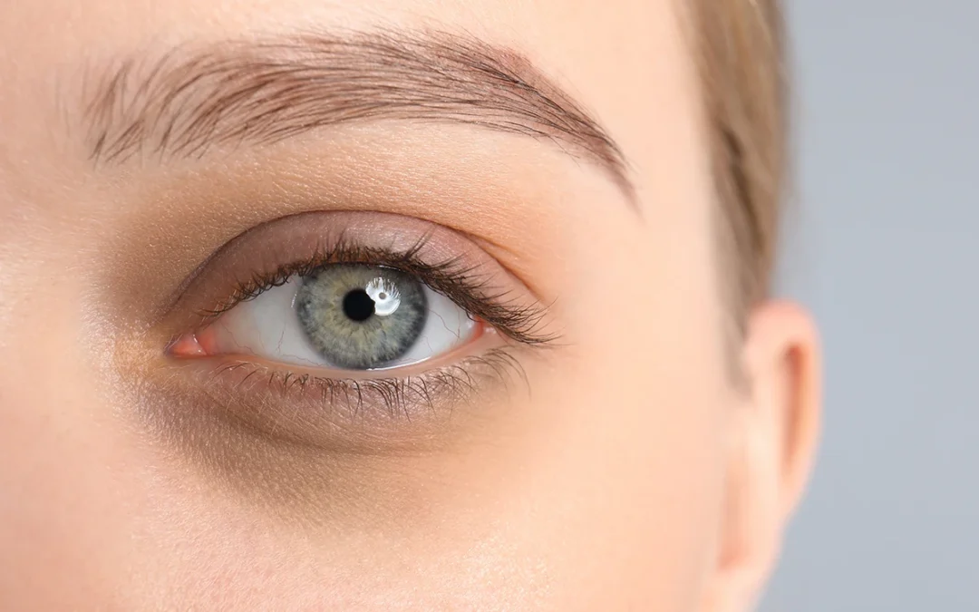 How IPL & RF Reduce Redness, Dark Circles, & Under Eye Bags