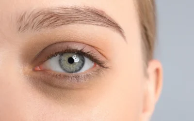 How IPL & RF Reduce Redness, Dark Circles, & Under Eye Bags