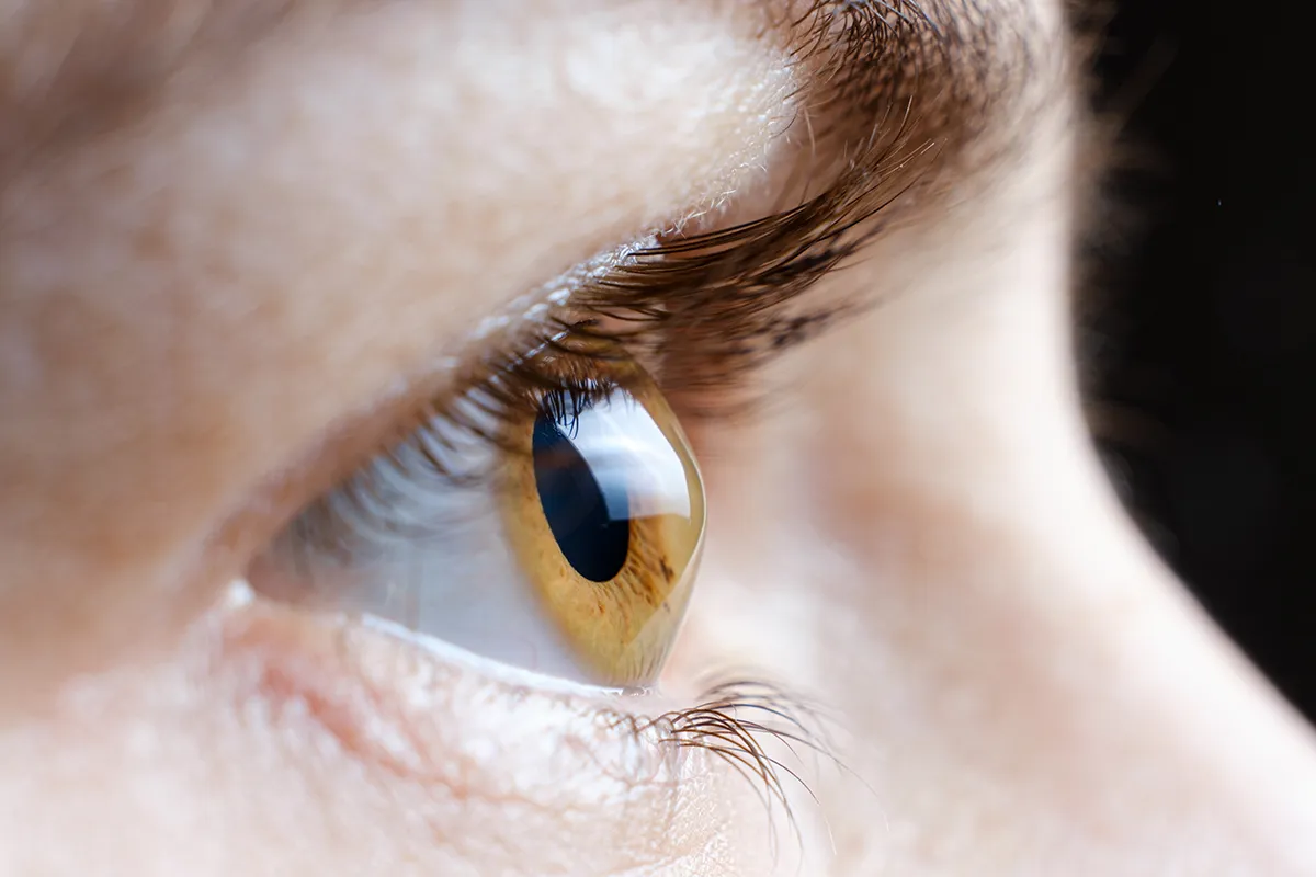 close-up of a woman's eye with keratoconus